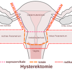 Hysterektomie, Gebärmutterentfernung