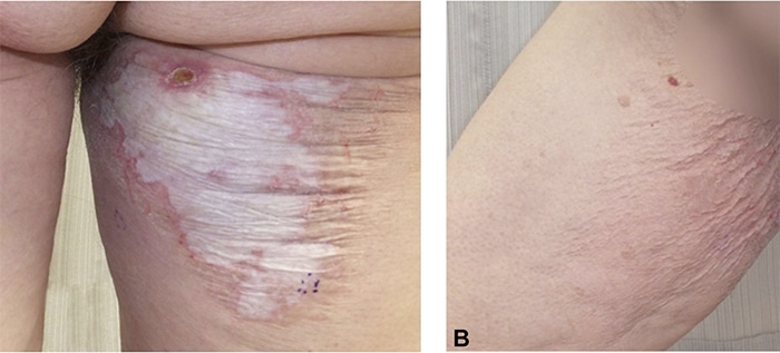 Lichen Sclerosus